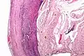 Micrograph of appendicitis and periappendicitis. H&E stain