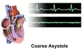 Ventricular Fibrillation
