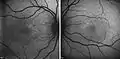 Fluorescent angiogram of a 5-year-old boy with HJMD