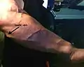 Basilic vein, muscular right forearm.