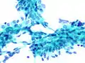 Fibroadenoma, Fine Needle Aspiration Biopsy (Papanicolou stain).  The image shows a sheet of epithelial cells in the typical antler pattern.