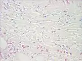 Gram stain of a muscle biopsy showing Gram-positive, rod-shaped, anaerobic, spore-forming bacteria in the infected muscle tissue: The result is highly compatible with an infection with C. perfringens.