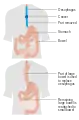 An esophagectomy using the bowel (colon) to replace the esophagus