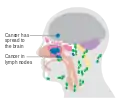 Maxillary sinus cancer that has spread to the brain