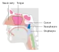 Stage T2 nasopharyngeal cancer