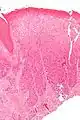Micrograph of differentiated vulvar intraepithelial neoplasia. H&E stain.
