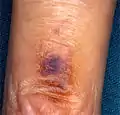 Possible smoker's melanosis. Discoloured skin on finger. Area close to cigarette glow.