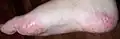 Advanced stage of dyshidrosis on the foot.