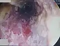 A severe case of candidiasis