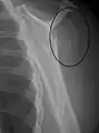 A fracture of the greater tuberosity of the humerus