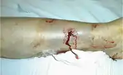 Gustilo type I open fracture