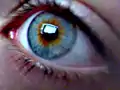 Human eye with central heterochromia showing an orange-brown to blue iris.