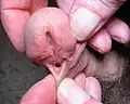 Example of penis with hypospadias
