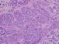 High-grade invasive ductal carcinoma, with minimal tubule formation, marked pleomorphism, and prominent mitoses, 40x field