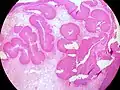 Inverted Schneiderian Papilloma of the Nasal Cavity.