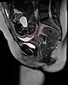 Conjugata vera as measured on sagittal MRI