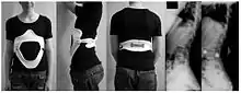 Modern brace for the treatment of lumbar or thoracolumbar kyphosis. The brace is constructed using a CAD/CAM device. Restoration of the lumbar lordosis is the main aim.