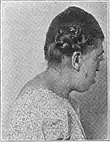 Pfeiffer syndrome (turribrachycephaly)