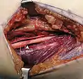 Operating field after removal of the lipoma: Arrow marks the median nerve that was compressed by the lipoma.