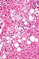 Micrograph showing a Mallory body. Original magnification 400X. H&E stain.