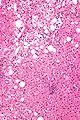 Micrograph showing a Mallory body. Original magnification 200X. H&E stain.