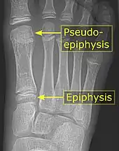 It is common in children to have a pseudo-epiphysis of the first metatarsal.