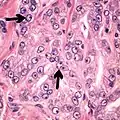 Acinar adenocarcinoma with double and eccentric nucleoli.