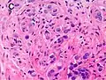 Gleason score 10 (5+5) with individual cells