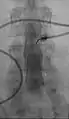 Myelography punction