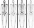Normal bone scan in a person with osteopoikilosis