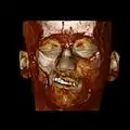 A 3D, soft tissue reconstruction of a CT scan of a 17-year-old girl with Parry Romberg syndrome.