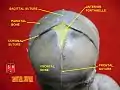 Sagittal suture.