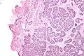 Micrograph of a Sertoli cell nodule. H&E stain.