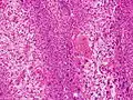 Clear-cell squamous-cell carcinoma