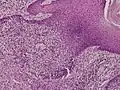Eccrine poroma
