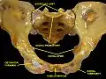 Anterior view of the pelvis with the ischial tuberosity labelled in the lower part of the image