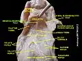 Median Glossoepiglottic fold