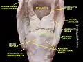Arytenoid cartilage
