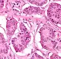 Neuroendocrine tumour of the small intestine with salt-and-pepper chromatin. H&E stain.