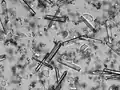 Struvite crystals in a human urine sample with a pH of 9. Abundant amorphous phosphate crystals, several squamous and non-squamous epithelial cells and a few leukocytes can also be observed.