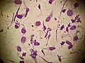 Tadpole cells on a smear taken from a patient with allergic contact dermatitis (May-Grünwald Giemsa x1000).
