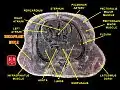 Transverse section of thorax featuring subscapularis muscle