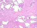 Appearance of usual interstitial pneumonia (UIP) in a surgical lung biopsy at low magnification. The tissue is stained with hematoxylin (purple dye) and eosin (pink dye) to make it visible. The pink areas in this picture represent lung fibrosis (collagen stains pink). Note the "patchwork" (quilt-like) pattern of the fibrosis.