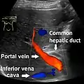 Borderline of a dilated perihilar bile duct, measuring 8&nbsp;mm.