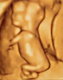 3D ultrasound of 80-millimetre (3 in) fetus (about .mw-parser-output .frac{white-space:nowrap}.mw-parser-output .frac .num,.mw-parser-output .frac .den{font-size:80%;line-height:0;vertical-align:super}.mw-parser-output .frac .den{vertical-align:sub}.mw-parser-output .sr-only{border:0;clip:rect(0,0,0,0);clip-path:polygon(0px 0px,0px 0px,0px 0px);height:1px;margin:-1px;overflow:hidden;padding:0;position:absolute;width:1px}3+1⁄2 months gestational age)