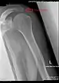 Radiograph of the shoulder showing an os acromiale