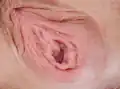 A post-pubertal hymen. Appearance is highly variable.